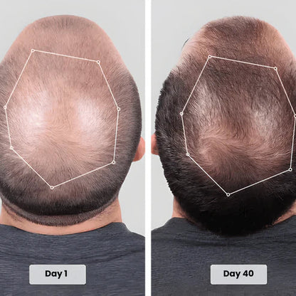 ed Light Therapy Cap for Hair Regrowth ✨🧢